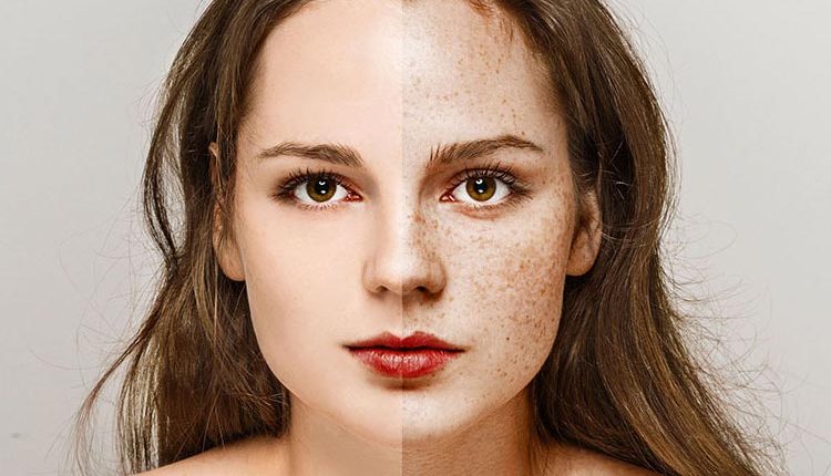 درمان کک و مک