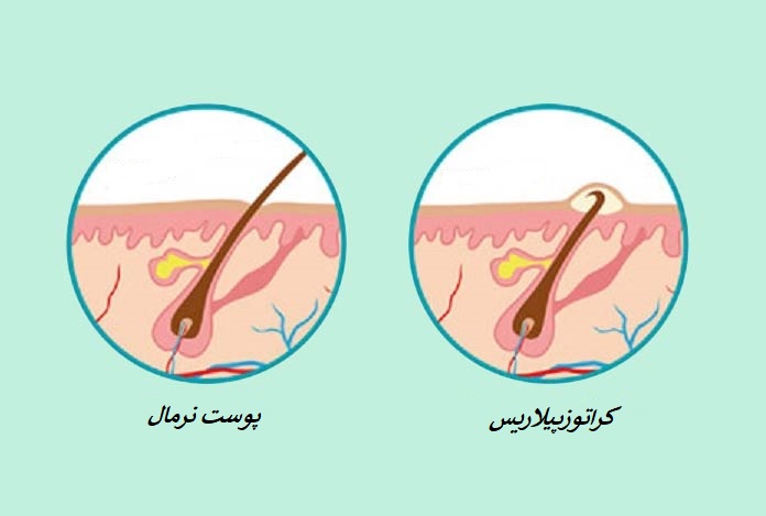 پوست مرغی