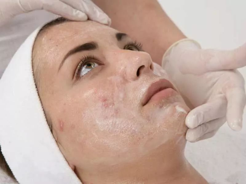 لایه بردار شیمیایی