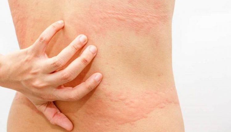 راه های درمان کهیر