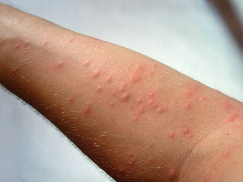 درمان التهاب پوست