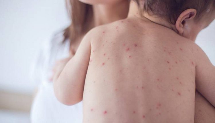 درمان کهیر در کودکان چگونه است؟