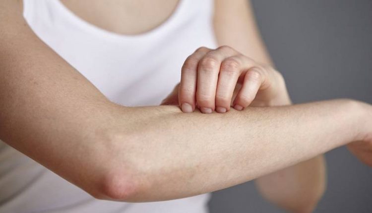 9 روش برای درمان خانگی کهیر