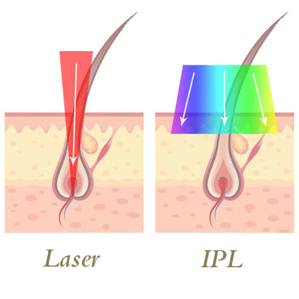تفاوت عملکرد لیزر و IPL