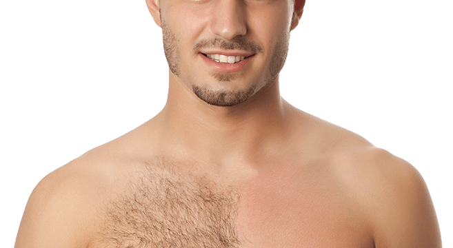 از بین بردن موهای زائد سینه مردان