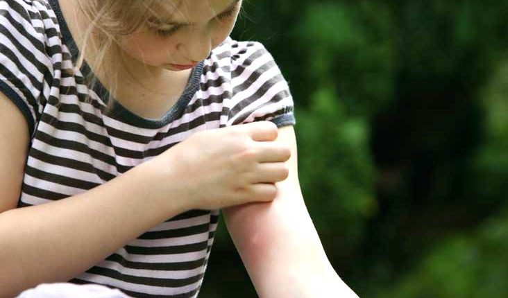 خارش پوست در بهار