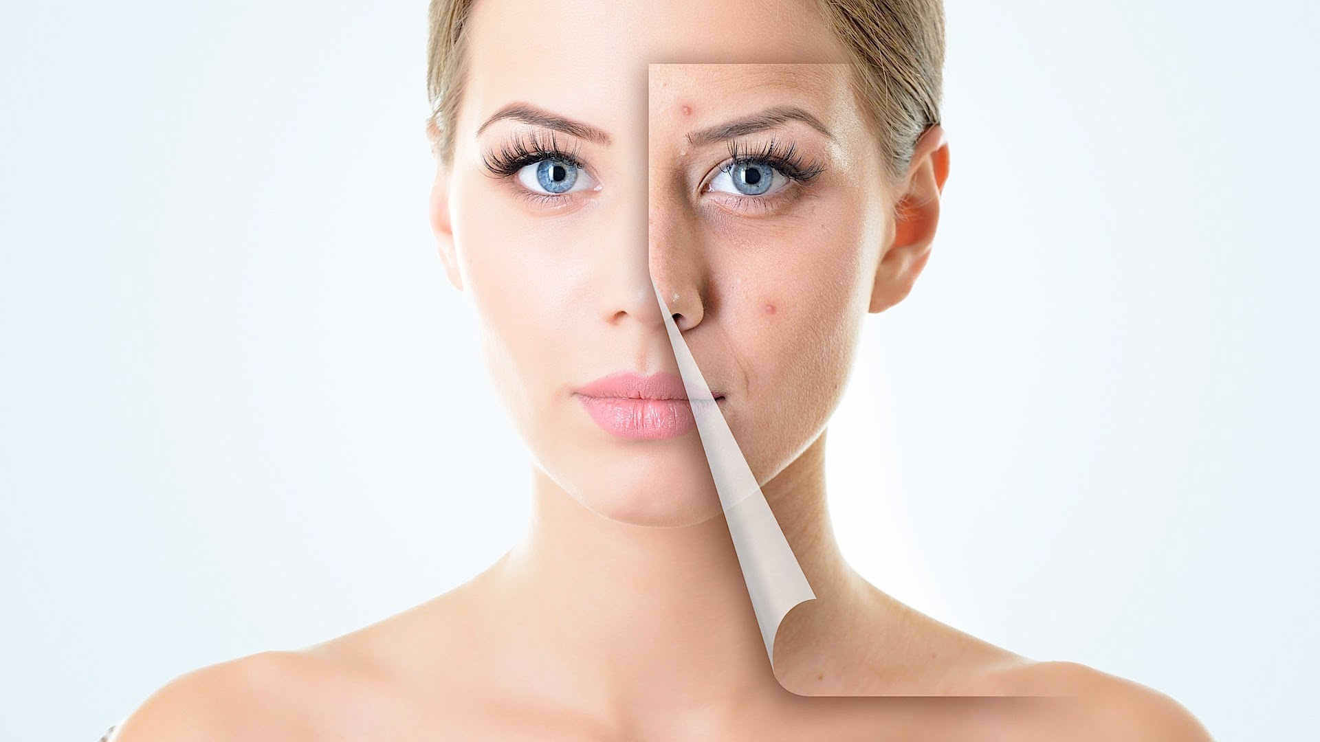 روش های مختلف برای رفع جای آکنه