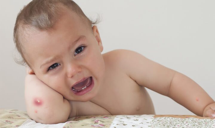 علت جوش های آبدار در کودکان