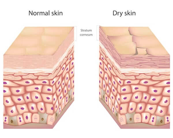 علل خشک شدن پوست