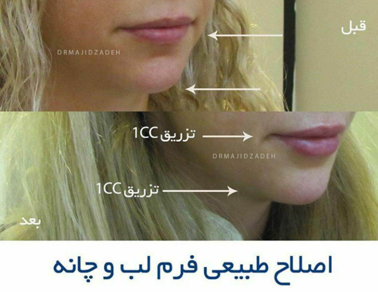 عکس قبل و بعد از تزریق ژل چانه