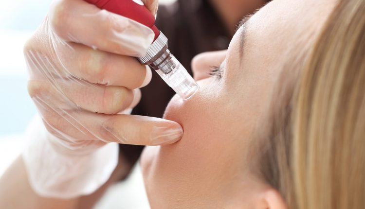 مزوتراپی برای لک صورت