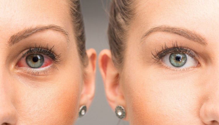 درمان پف زیر چشم