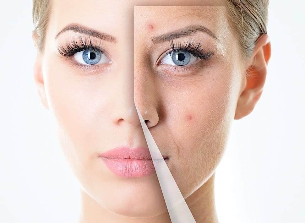 قبل و بعد از مزوتراپی