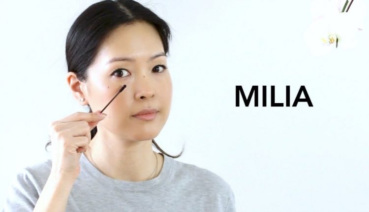 میلیا یا جوش سفید زیر پوستی