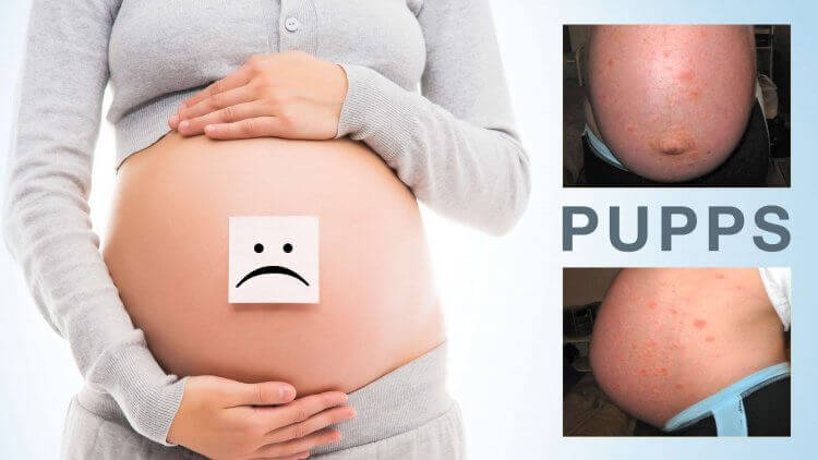 pupps در بارداری