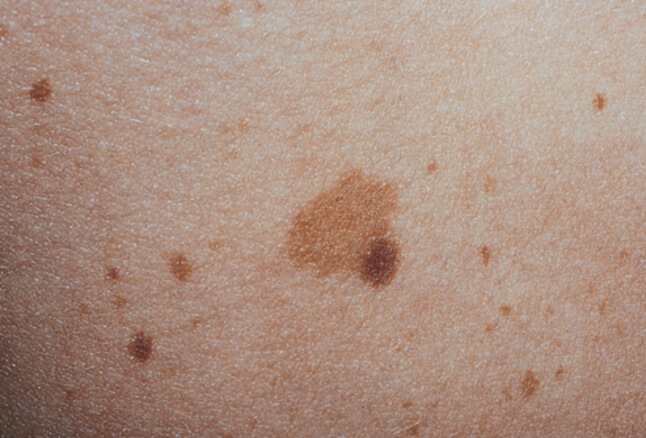 لنتیجین پوست