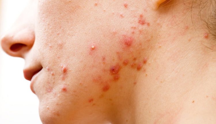 جوش خط فک چیست