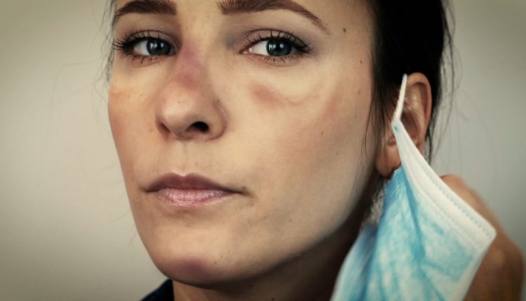 زخم شدن ماسک زیر پوست