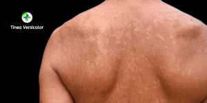 درمان قطعی تینه آ ورسیکالر