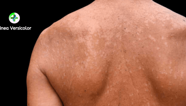 درمان قطعی تینه آ ورسیکالر