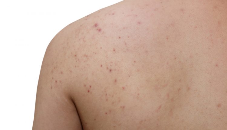 علت جوش روی بازو و پشت