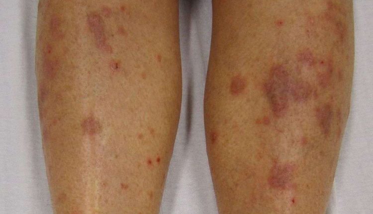علت دانه های قرمز روی ساق پا