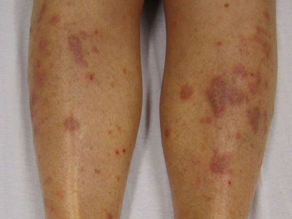 علت دانه های قرمز روی ساق پا