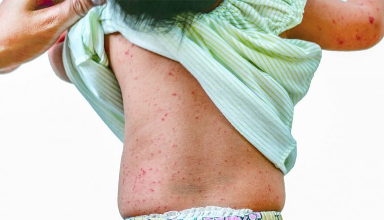 روزئولا در بزرگسالان