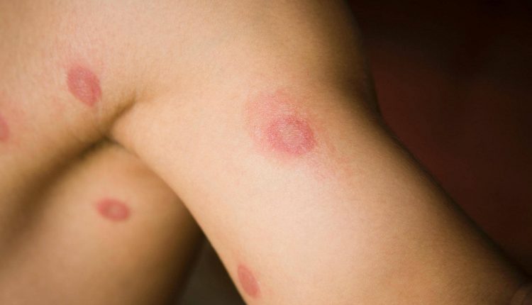 درماتوفیتوز