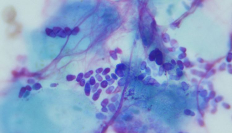 درمان قطعی قارچ مالاسزیا