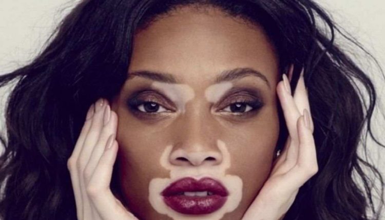 بیماری ویتیلیگو