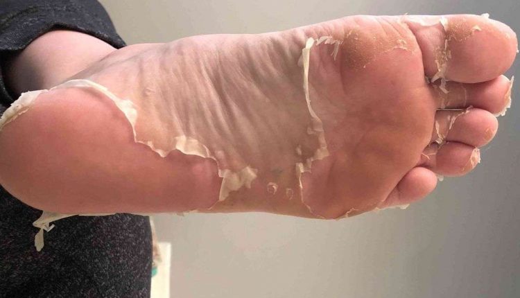 پوسته شدن کف پا