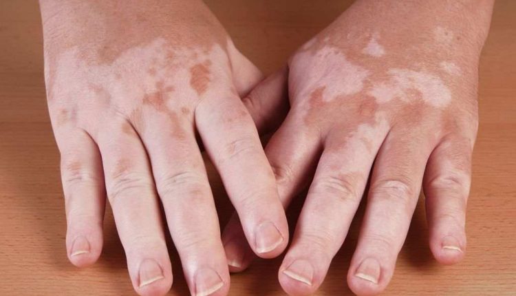 لکه های سفید روی پوست