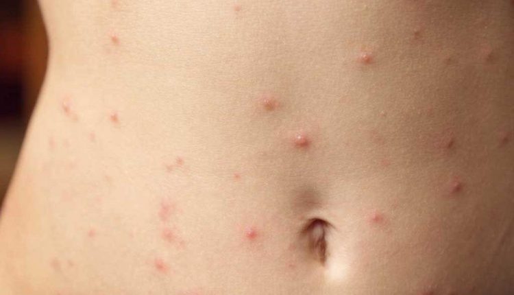 جوش روی شکم