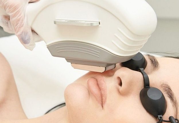 لیزر موهای زائد